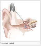 Illustration of a cochlear implant, betwee the ear and the cochlea